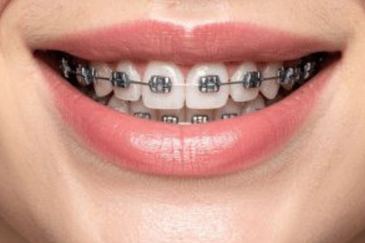 Metal Braces Treatment
